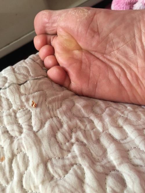 脚底部这种纹路是老年痴呆症的前奏吗