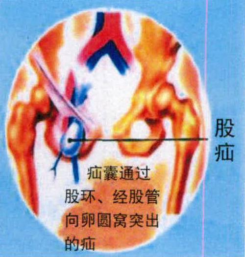 (图) 股疝示意图