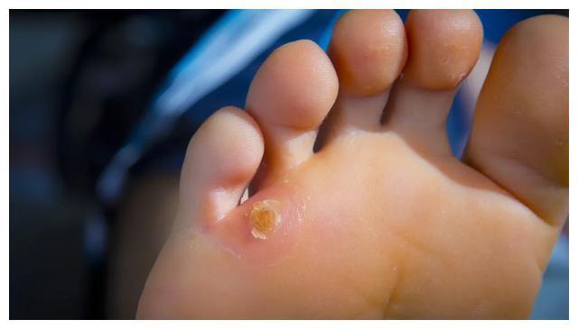 长期站立或行走鸡眼的发生常常是因为我们脚经常受到挤压,我们上时间