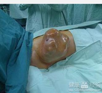 如何缓解晚期乳腺癌患者疼痛