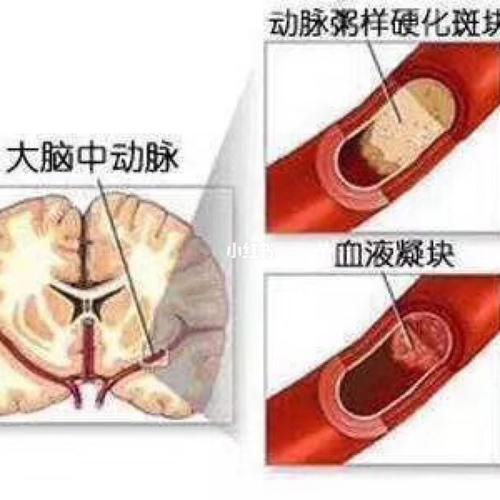 7215提醒各位家人和朋友们～脑梗,脑血管疾病,会导致猝然昏倒
