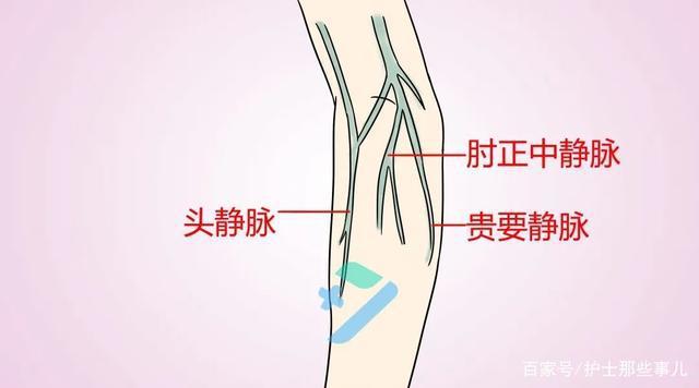 静脉穿刺总失败别慌这些技巧你一定用得上