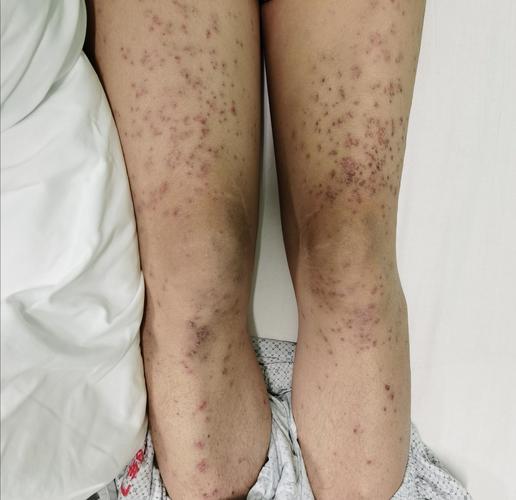 系统性红斑狼疮皮疹