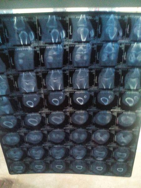 ct平扫 三维重建示 . 右股骨内髁及右胫骨内侧平台骨折.