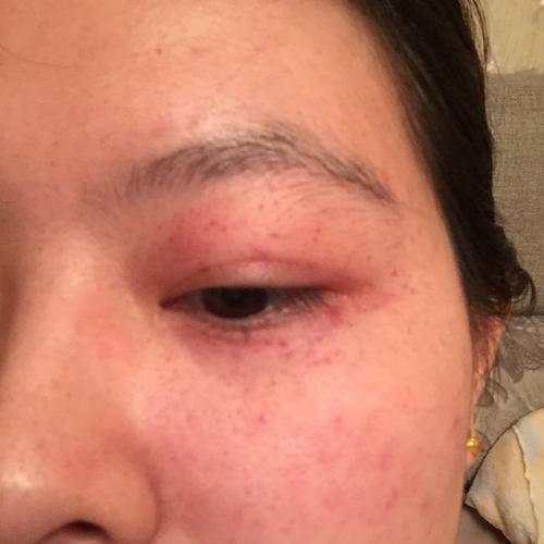 眼角周围都是红色小点点,脸上脖子上都有
