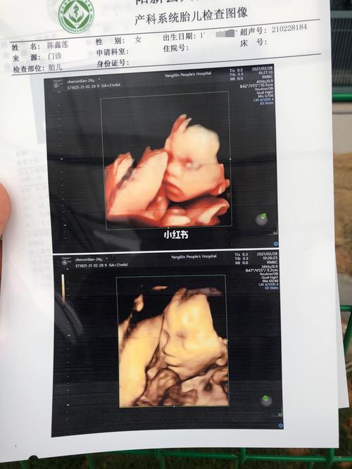 孕21周776  四维彩超_四维彩超_女宝_四维猜男女_母婴_孕产经验