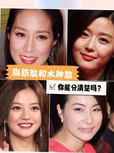 "脂肪脸"和"水肿脸"你能分清楚吗?