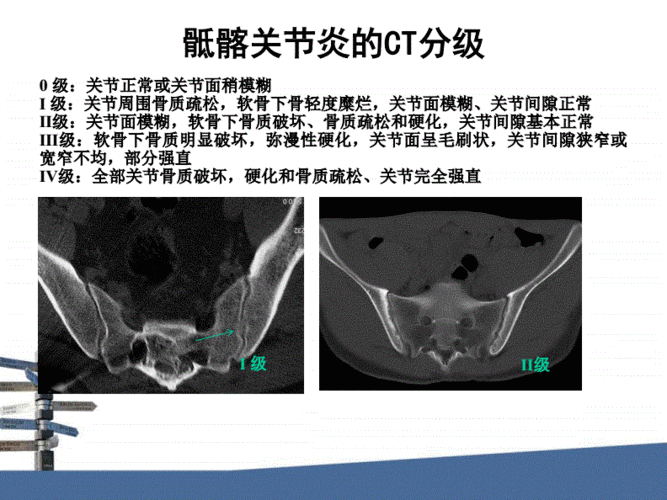 骶髂关节炎的评分比较-影像ftp.pdf 23页