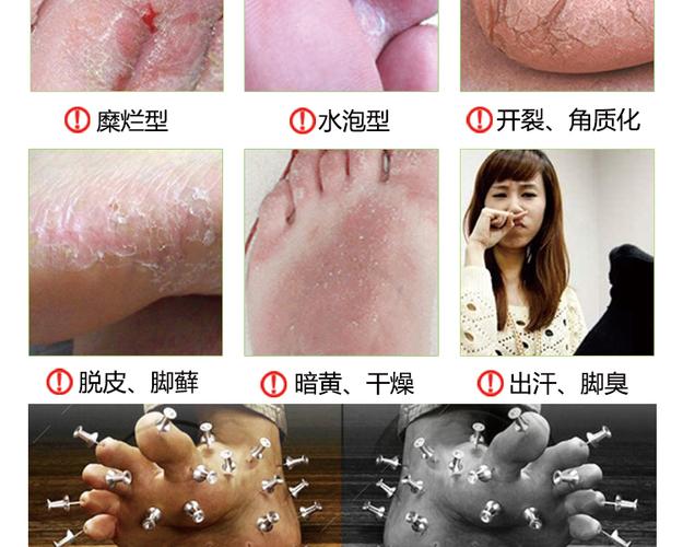 海步足康喷剂20ml脚气药脚气喷剂脚痒脚脱皮烂脚丫根治脚臭特效包邮