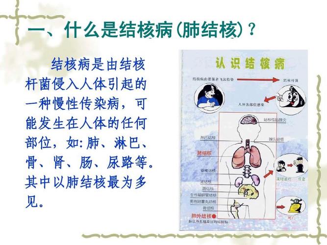 写美篇 (一)结核病又叫"痨病",由结核杆菌引起,主要侵害人体肺部,发生