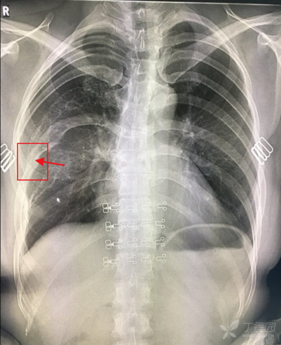 其中右第7肋骨似有骨折后畸形愈合的表现,亦符合骨纤维异常增殖症易伴