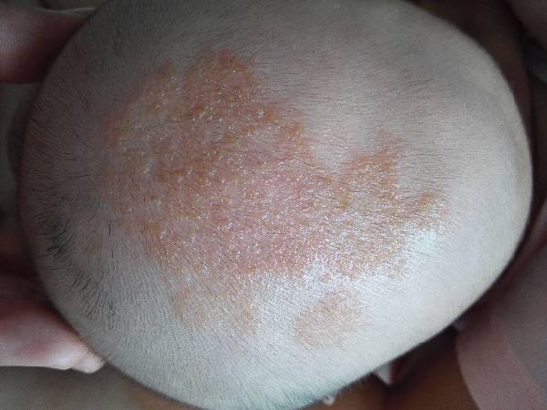 请问宝宝头皮这是长得什么啊?有人说是湿疹,就摸了香油.谢谢了.