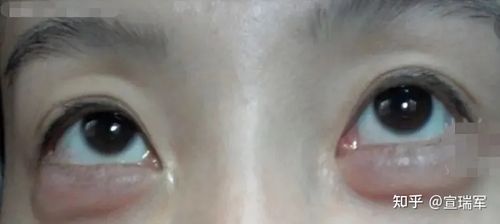 先天性眼轮匝肌肉肥厚型眼袋