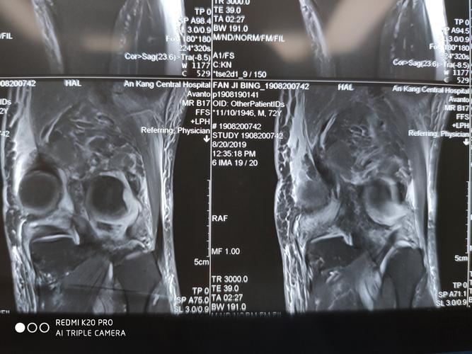 膝关节脱位,多发韧带损伤kt四型损伤一期关节镜检查后