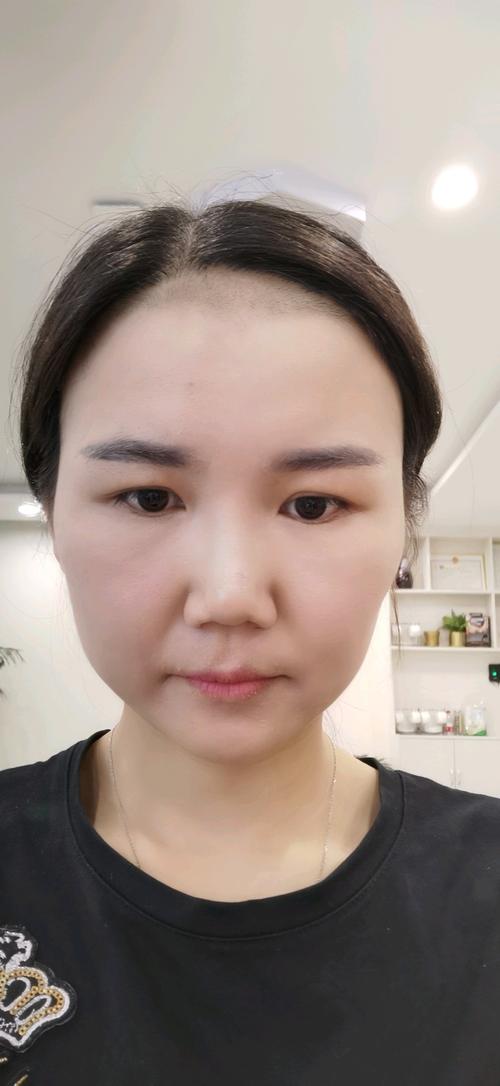 原来在其他地方脱的发际线,脱了五次,但是效果不是太