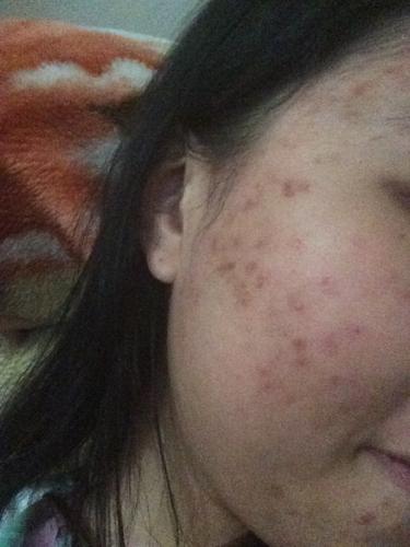 痘痘结痂了好几天扣掉了没流血但是有印子 多久会淡掉