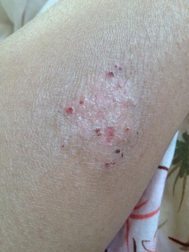 2013-12-16 16:04机器小叮当q|来自手机知道| 分类:皮肤科  