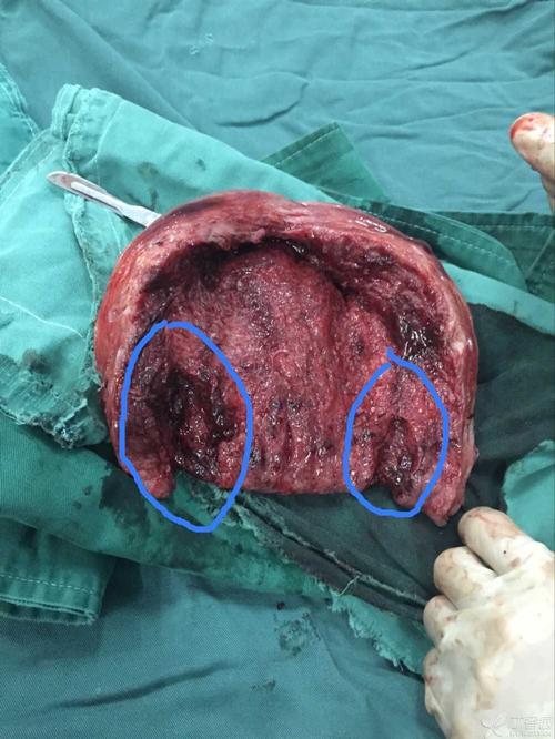 猛回头-警世钟——盘点那些阴道分娩后恐怖的软产道裂伤出血