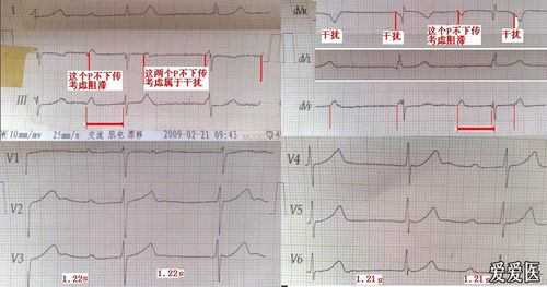 于 2011-5-18 09:03 编辑   我的看法:首先这幅图左右手反接