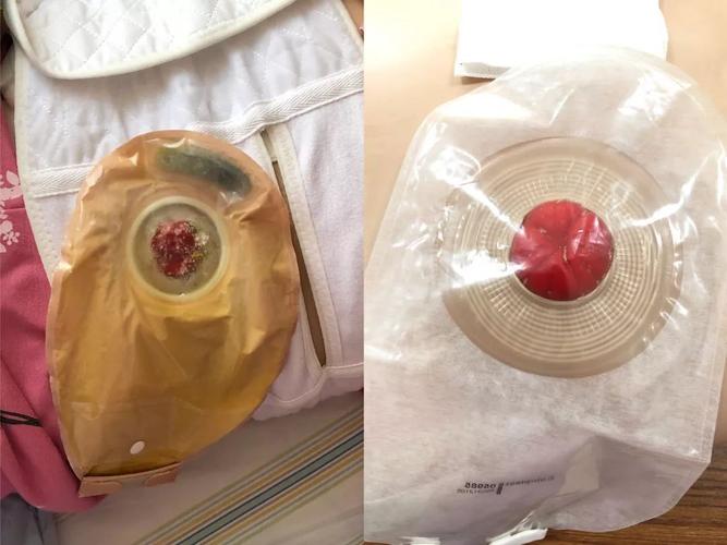 人工肛门—造口