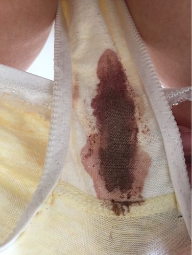 排卵期出血怎么办