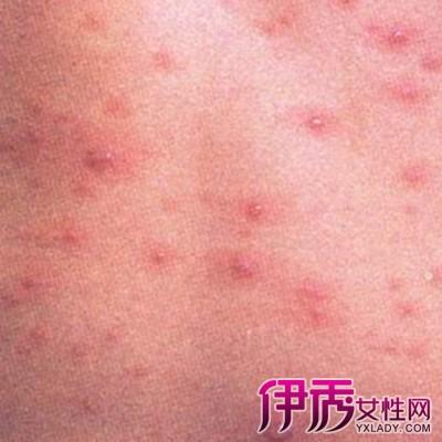 收集艾滋病初期皮疹图片 艾滋病初期症状出现在身体哪些部位