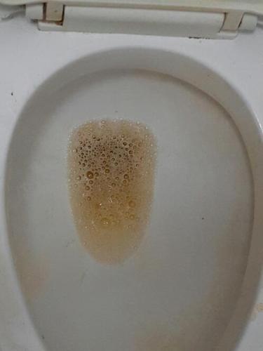 尿中经常出现大量泡沫且长时间不散去医院检查了三次尿常规尿蛋白阴性