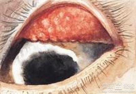 流行性角结膜炎怎么办