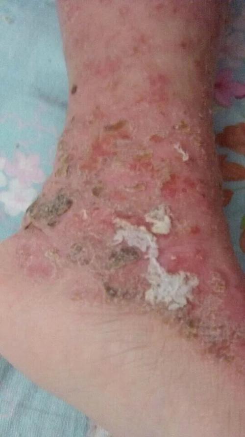 门诊治疗一例四川严重特异性皮炎小儿恢复过程记录