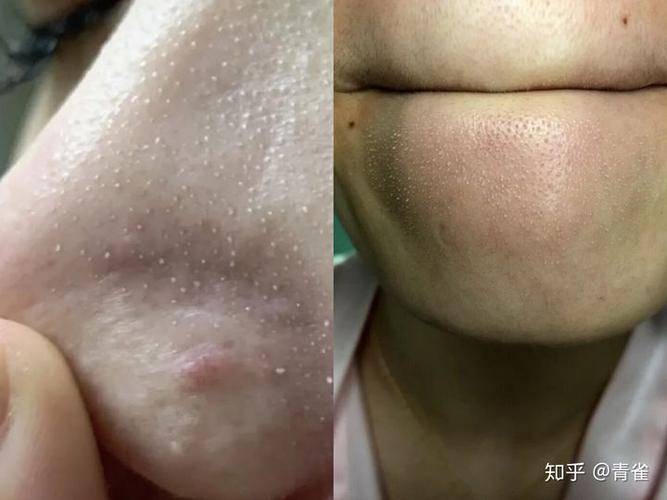 从毛孔中探出头的皮脂是白头,不止鼻子会长白头,鼻翼和下巴能挤出来