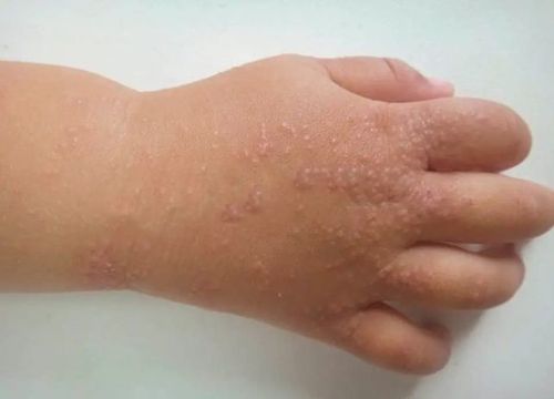 皮肤病方面不熟悉的儿科医生,很容易把其他儿童皮肤病误诊为此类疾病