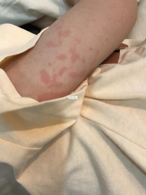 一岁半宝宝出红疹子_过敏_红疹_荨麻疹_止痒_母婴