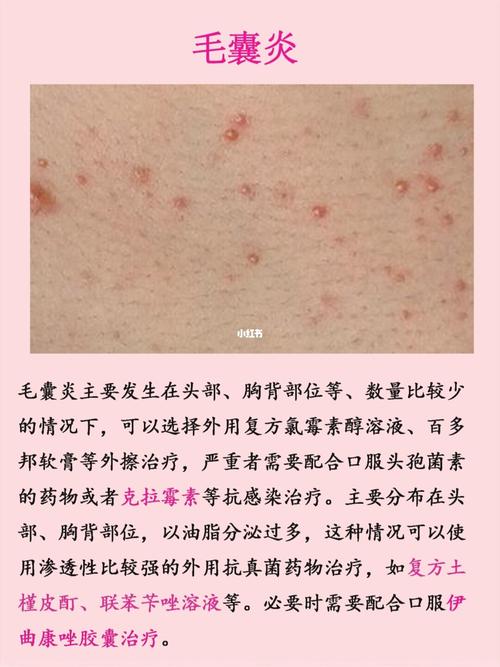 学会辨别皮肤病的种类_皮肤病_皮炎_皮肤问题_湿疹_医疗健康_医疗药品