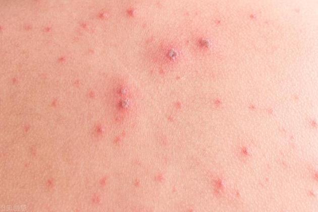 身上出现红色疹子"艾滋病"在出现之前,皮肤会有哪些症状?
