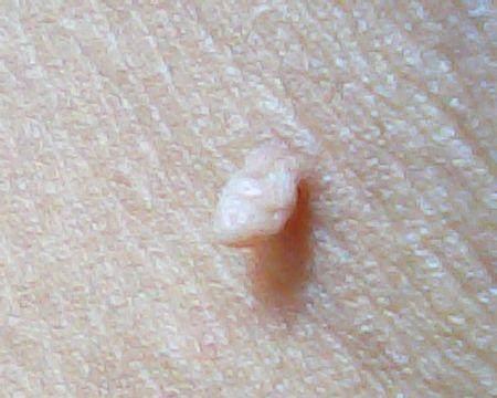 脖子上的小肉球越长越多,是皮肤癌变吗?会传染吗?