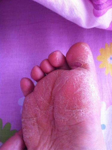 尤其是糖尿病患者,脚一有感染或发炎症状要赶紧就医,以免引