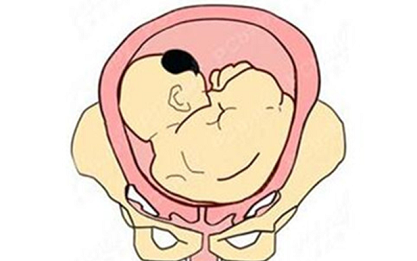 你的胎儿突然变为臀位可能是这6个原因