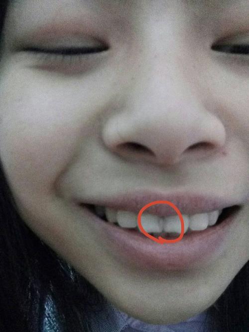 懂牙科的人帮我看看为什么两颗门牙中间慢慢变透明吧,强光下貌似透明