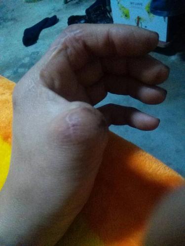 我左手母指残缺,想考驾照,请问现在能让考试不, 我前两天去了驾校