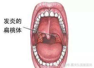 重庆弘医堂耳鼻喉医院分享扁桃体炎反复发作的病因