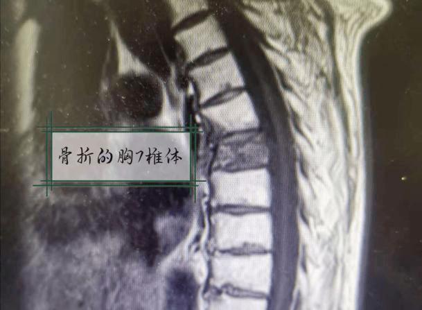【硬实力】警惕!胸痛的又一"凶手",胸椎压缩性骨折