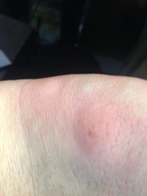 我想知道这是什么虫子咬的是臭虫还是跳骚什么的?不是