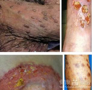女人梅毒有什么症状