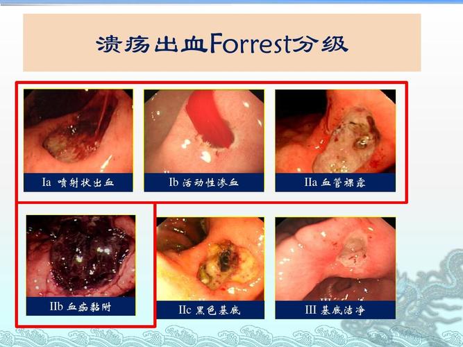 非静脉曲张上消化道出血-欧洲指南建议ppt