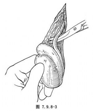 附睾疾病及附睾切除术