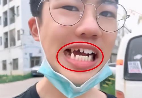 17岁儿子长尖牙,亲妈吐槽像"吸血鬼",网友:也可能是个