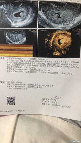 [试管婴儿]一超结果出来了被这个绒毛膜凸起