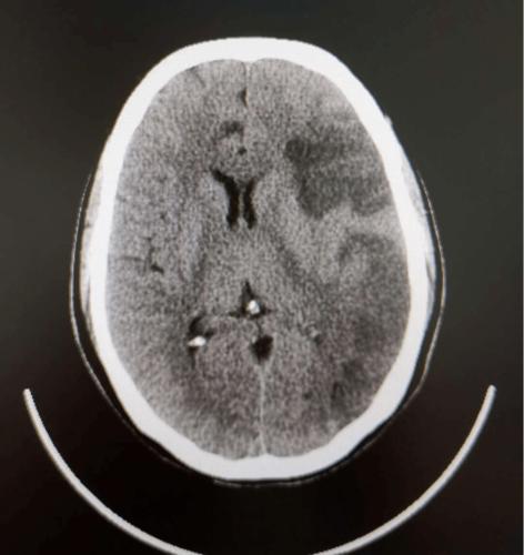 19日头颅ct提示左侧额颞顶枕叶大面积脑梗塞