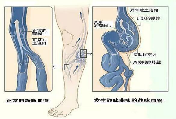静脉曲张,不痛不痒也危险!