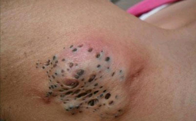 顶级黑头粉刺富矿